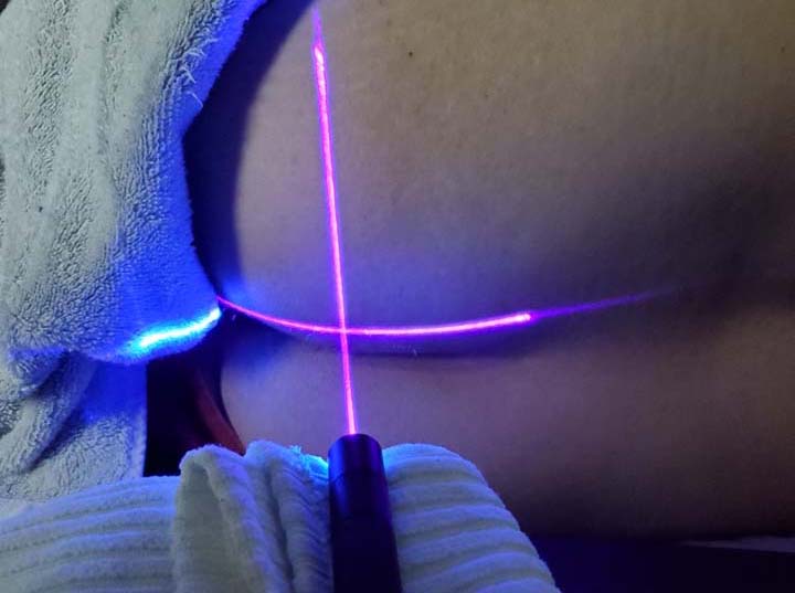a laser being used to heal a scar