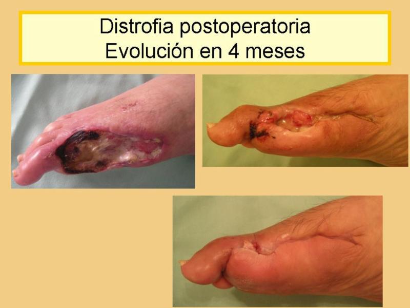 Diabetic Foot 2