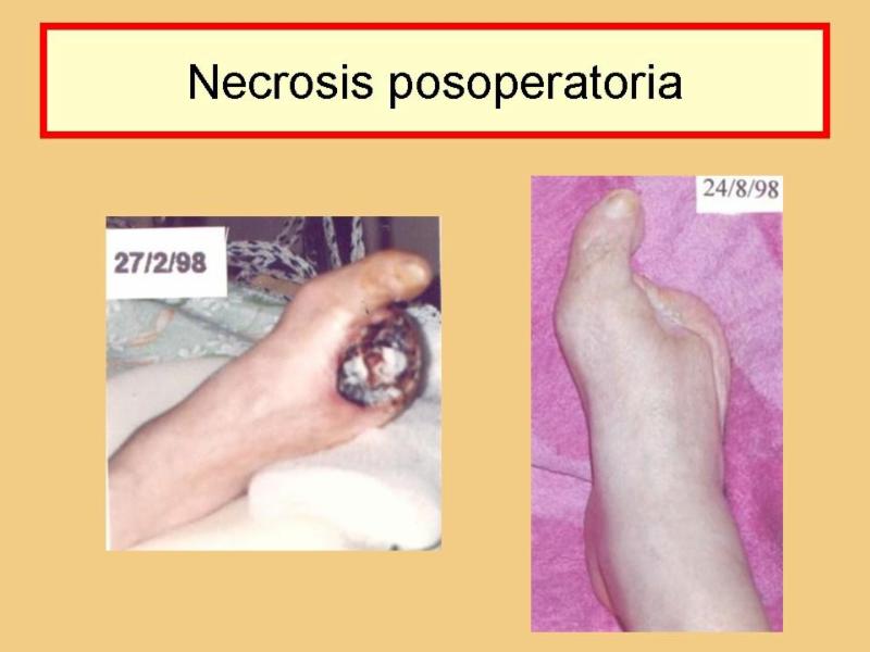 Diabetic Foot 1